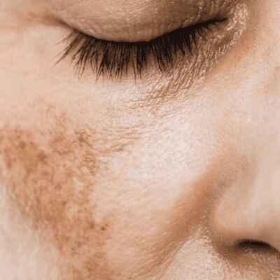 Melasma